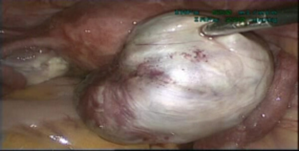 λαπαροσκόπηση - εικόνα 2