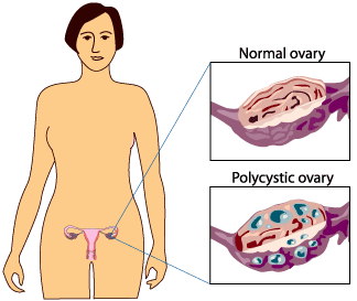 πολυκυστικές ωοθήκες - μορφολογία